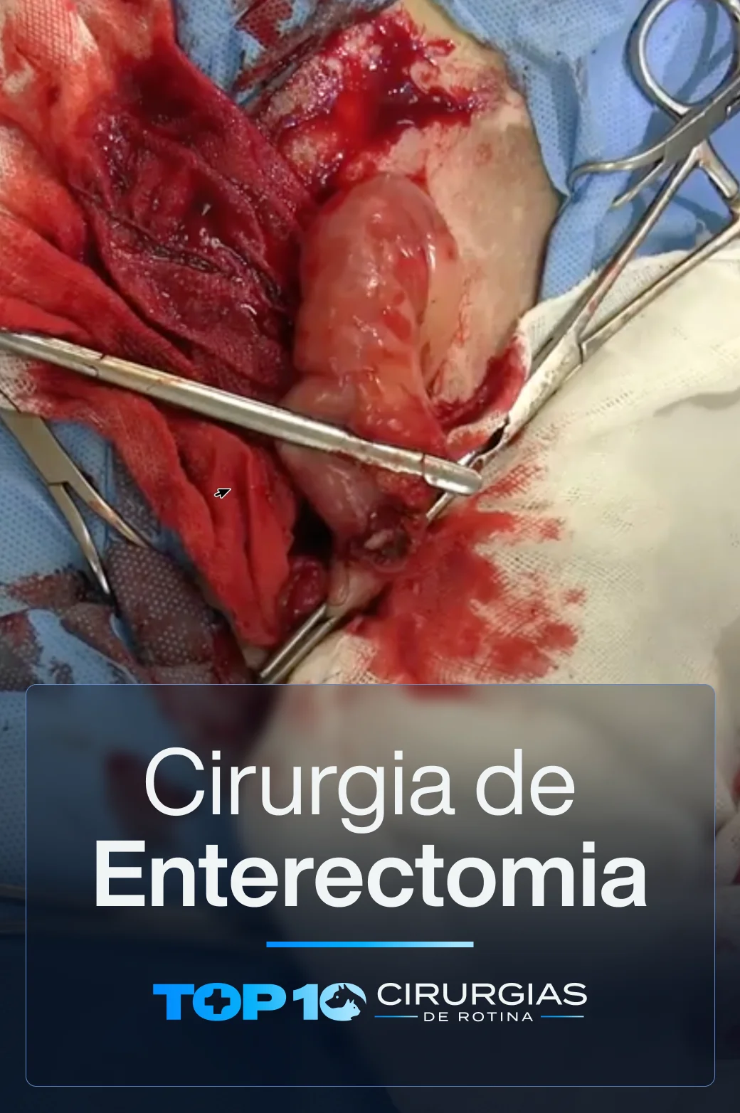 CAPA-TOP10-Enterectomia