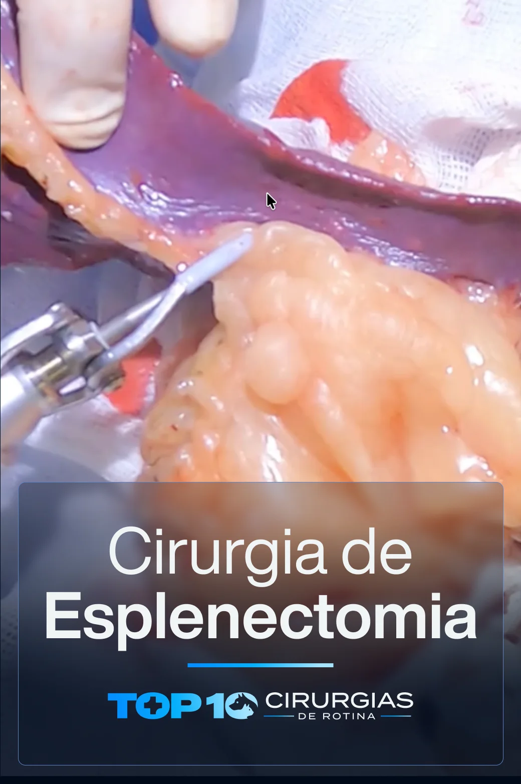 CAPA-TOP10-Esplenectomia