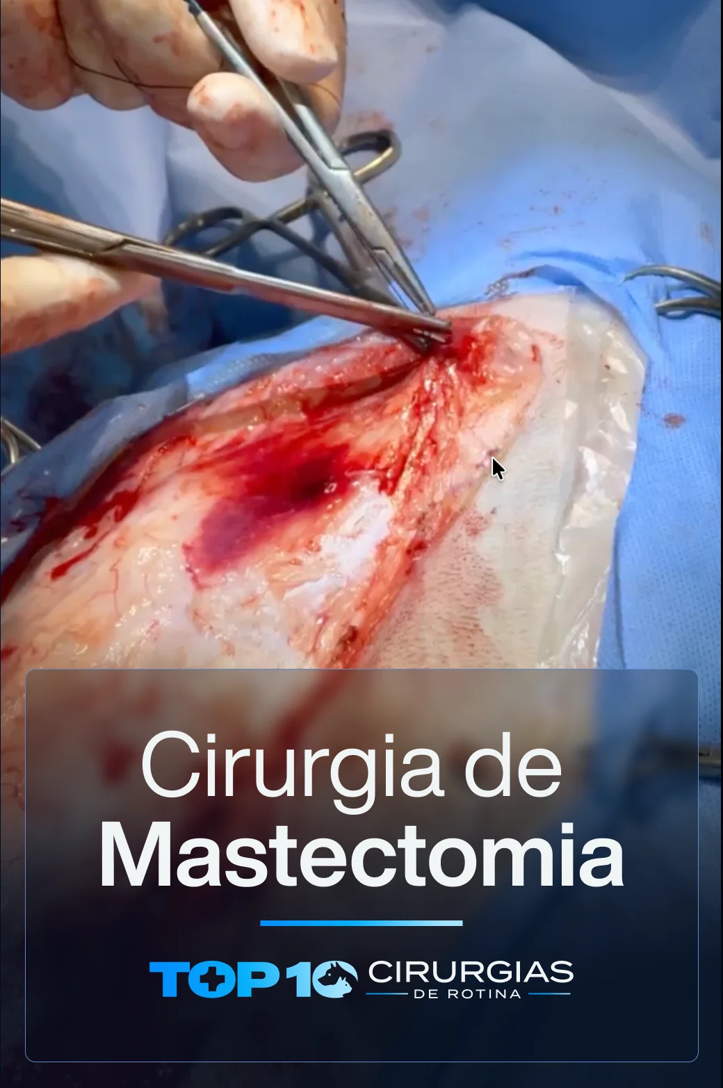 CAPA-TOP10-Mastectomia