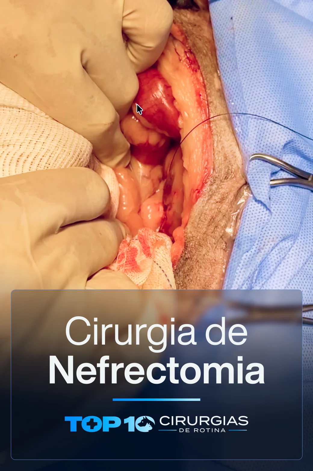 CAPA-TOP10-Nefrectomia