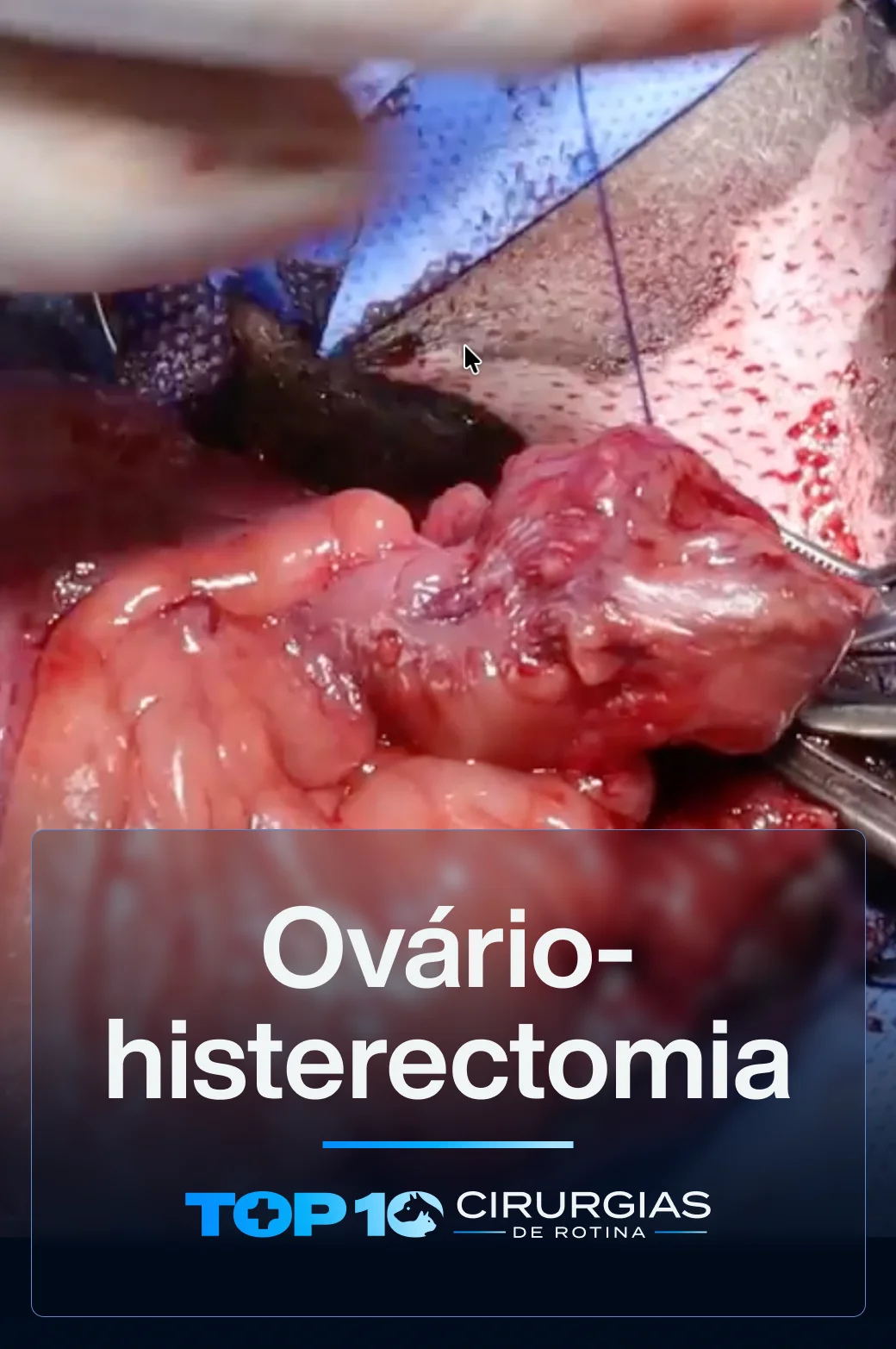 CAPA-TOP10-Ovário-histerectomia